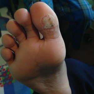 Verrucae treatment before