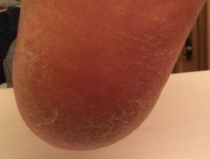 Before treatment of cracked heels