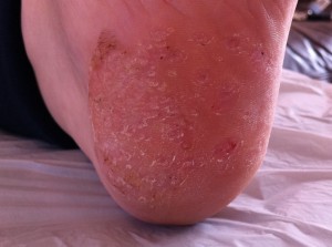 After the second marigold treatment